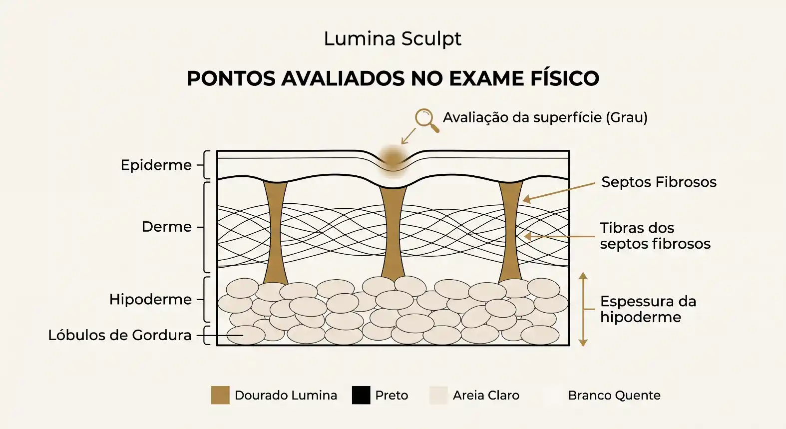 Ilustração médica em corte da pele com o esquema de avaliação da superfície (grau) e pontos avaliados no exame físico, mostrando epiderme, derme, hipoderme, septos fibrosos e lóbulos de gordura. Legenda com tons Dourado Lumina, Preto e Branco Quente.