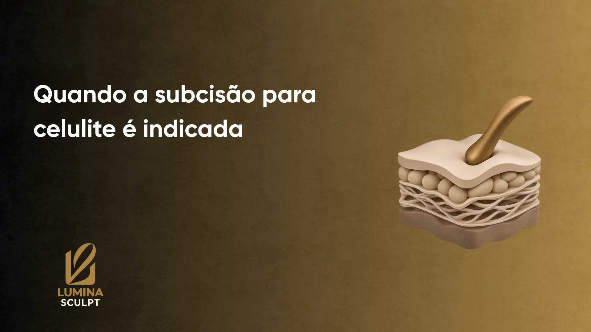 Imagem com ilustração em corte de camadas de pele e gordura, com um pequeno aplicador sobreposta, sugerindo informações sobre quando a subcisão para celulite é indicada. Texto: “Quando a subcisão para celulite é indicada”.